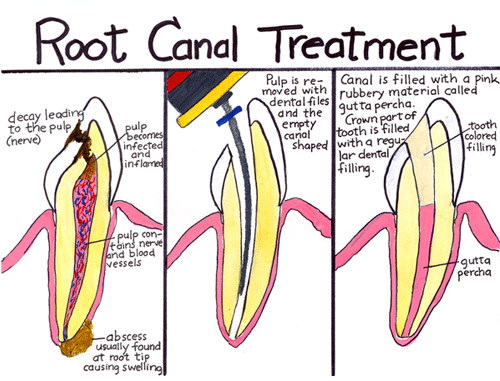 root canal