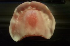 denture reline 1.1.jpg denture reline 1.1.jpg