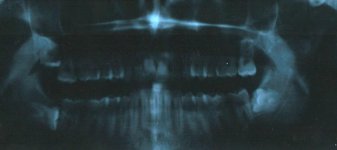wisdom teeth.jpg