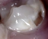 cavity4.jpg