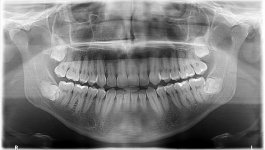 Wisdom teeth.jpg Wisdom teeth.jpg