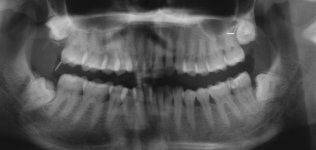 Yuni_xray_oct2012_crop1.jpg