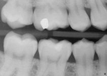 7_Right Molar .jpg