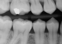 8_Right Premolar .jpg