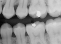 9_Left Premolar .jpg