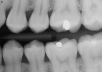 10_Left Molar .jpg