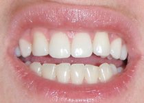 teeth.jpg
