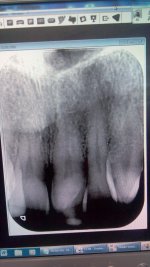 FRONT TOOTH 310316.jpg
