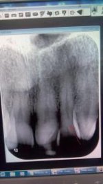 thistooth.jpg