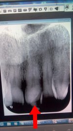 front tooth ache cracker 0316.jpg
