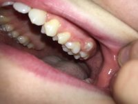 Through of tooth gum poking 