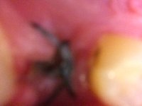 tooth2.JPG tooth2.JPG