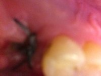 tooth3.JPG tooth3.JPG