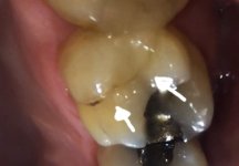 toothcrack.jpg toothcrack.jpg
