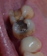 No Fill UL6 Molar.jpg