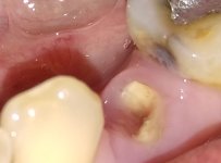 premolar.jpg