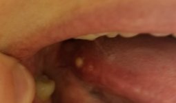 White pimple type bump on base of tongue