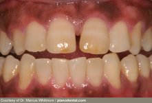 whitmore_rf_photo_of_diabetic_teeth_and-_gums.jpg