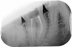Xray 1- LR6 root canal treatment- files shown in mb and ml canals. Grade 1..jpg