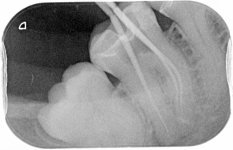 Xray 2- LR6 root canal treatment- master cone xray showing GP pounts in mb, ml and d canals. G...jpg