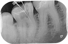 Xray 3- LR6 final xray- well condensed canals to within 1mm of root apices.jpg