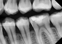 18_Lt Premolar BW.jpg