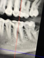 TOOTH4.JPG