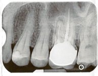 tooth1.jpg tooth1.jpg