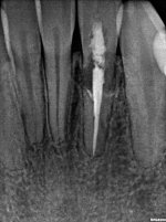 tooth #23 thumbnail_159.jpg