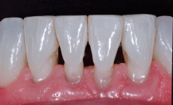 black-triangle-in-teeth-2-1-1.png black-triangle-in-teeth-2-1-1.png