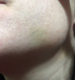 Bruise.jpg Bruise.jpg