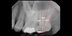 01_18_2024 Intraoral Periapical Image (1).jpeg