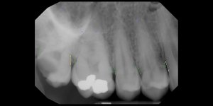 01_29_2024 Intraoral Periapical Image (1).jpeg