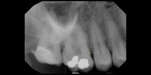 01_29_2024 Intraoral Periapical Image.jpeg
