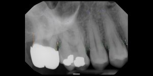 02_20_2024 Intraoral Periapical Image.jpeg