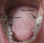 Tooth crown 2.jpg