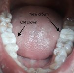 Tooth crown 3.jpg