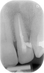 rct dental xray1.JPG