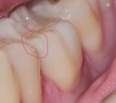 tooth fracture.jpg