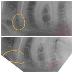Tooth LL5 Xray.jpg