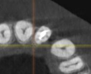 CBCT axial.jpg