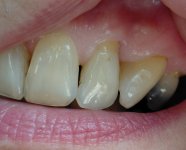 Gum bumps 07.26.jpg