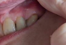 Gum bumps 09.24.jpg