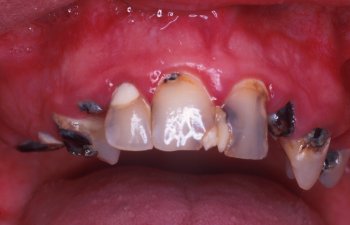 dental decay
