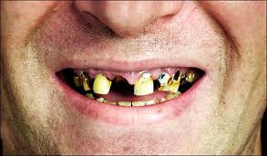 missing teeth