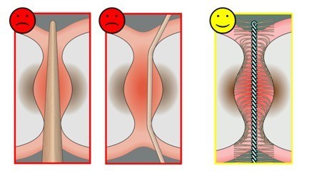 Illustration of how interdental brushes clean between back teeth to prevent gum disease