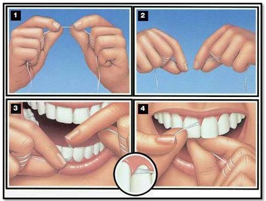 Step-by-step illustration of how to floss to prevent gum disease