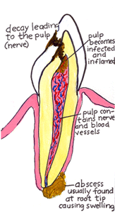 Drawing of a tooth which needs root canal treatment. If the pulp of the tooth becomes infected, an abscess can form at the the root tip and cause swelling and pain.