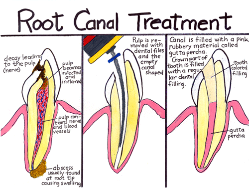 Step-by-step illustration of a root canal treatment. First, the pulp is removed with dental files and the empty canal shaped. Then, the canal is filled with gutta percha, and the crown part of the tooth is filled with a dental filling.